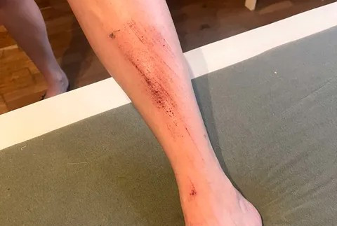leg abrasions