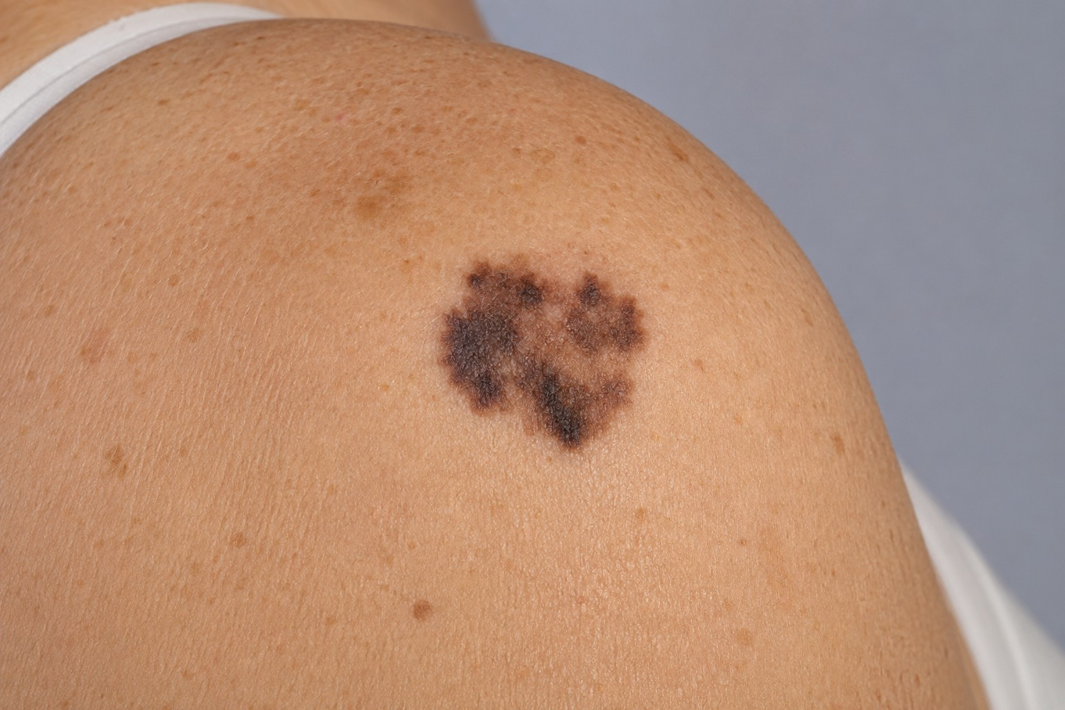 mole cancer skin