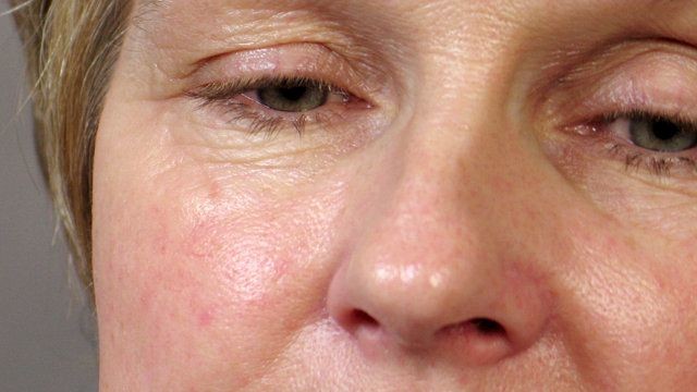 W przypadku cery naczynkowej i wrażliwej bardzo ważny jest dobór odpowiednich kosmetyków do demakijażu. Ponieważ skóra pani Ewy wymaga głębszego nawilżenia i skorygowania drobnych zmarszczek mimicznych, do demakijażu używam delikatnego mleczka i toniku z mikrokolagenem, rutyną i mikroelementami. Składniki te będą łagodzić podrażnienia i likwidować drobne pajączki. Mikrokolagen będzie działał jak botox – wypełni zmarszczki, korygując w ten sposób niedoskonałości skóry.