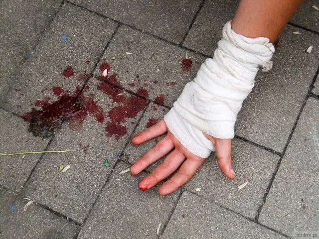 W czasie naszej wizyty jeden z chłopców ranił się w rękę. Wypadki w zaniedbanym skateparku są na porządku dziennym.