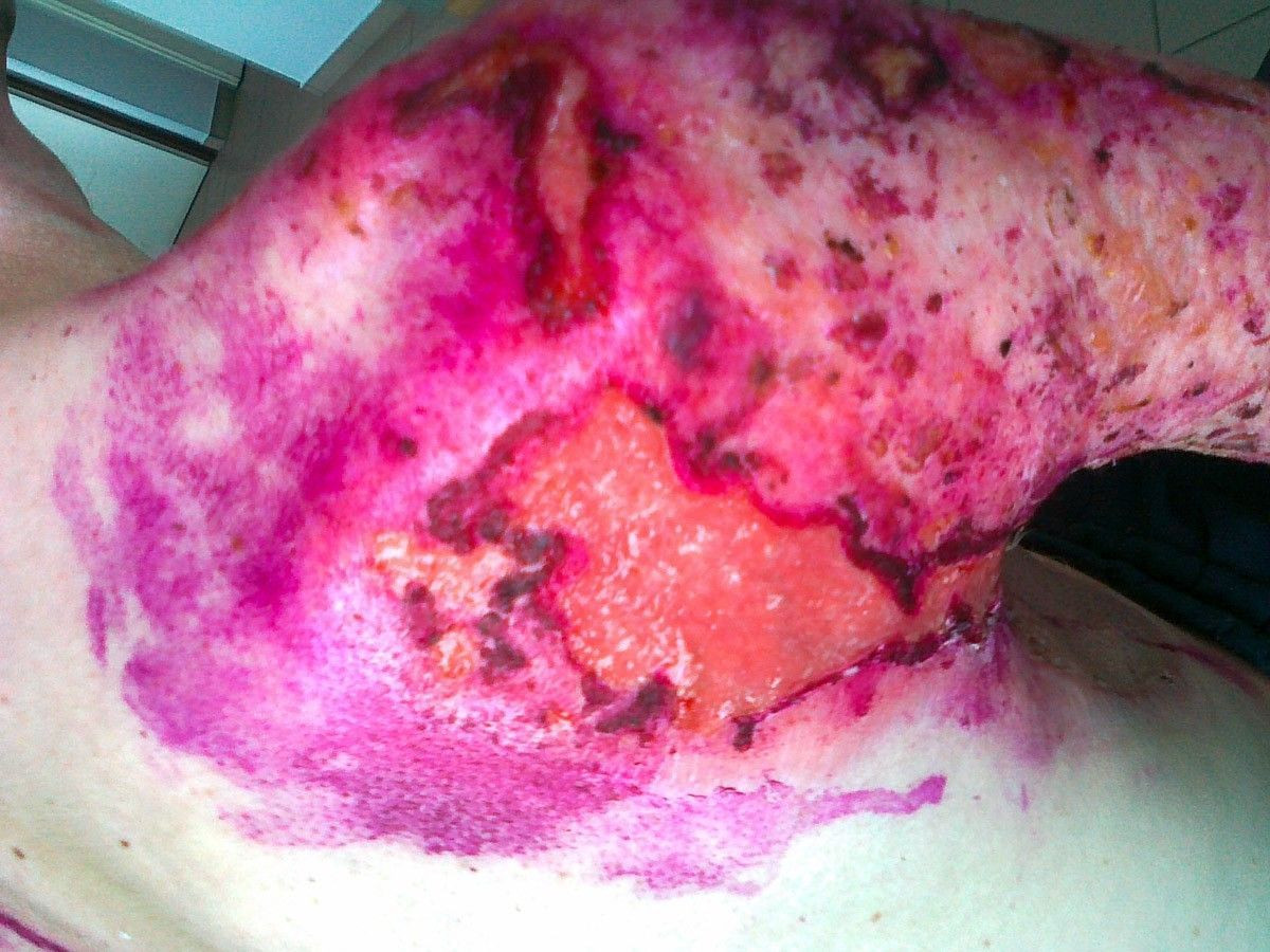 Tomasz Skiba po wypadku przy pracy