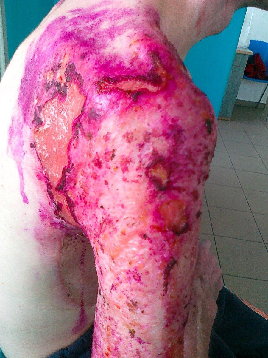 Tomasz Skiba po wypadku przy pracy