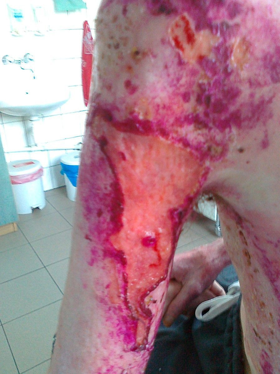 Tomasz Skiba po wypadku przy pracy