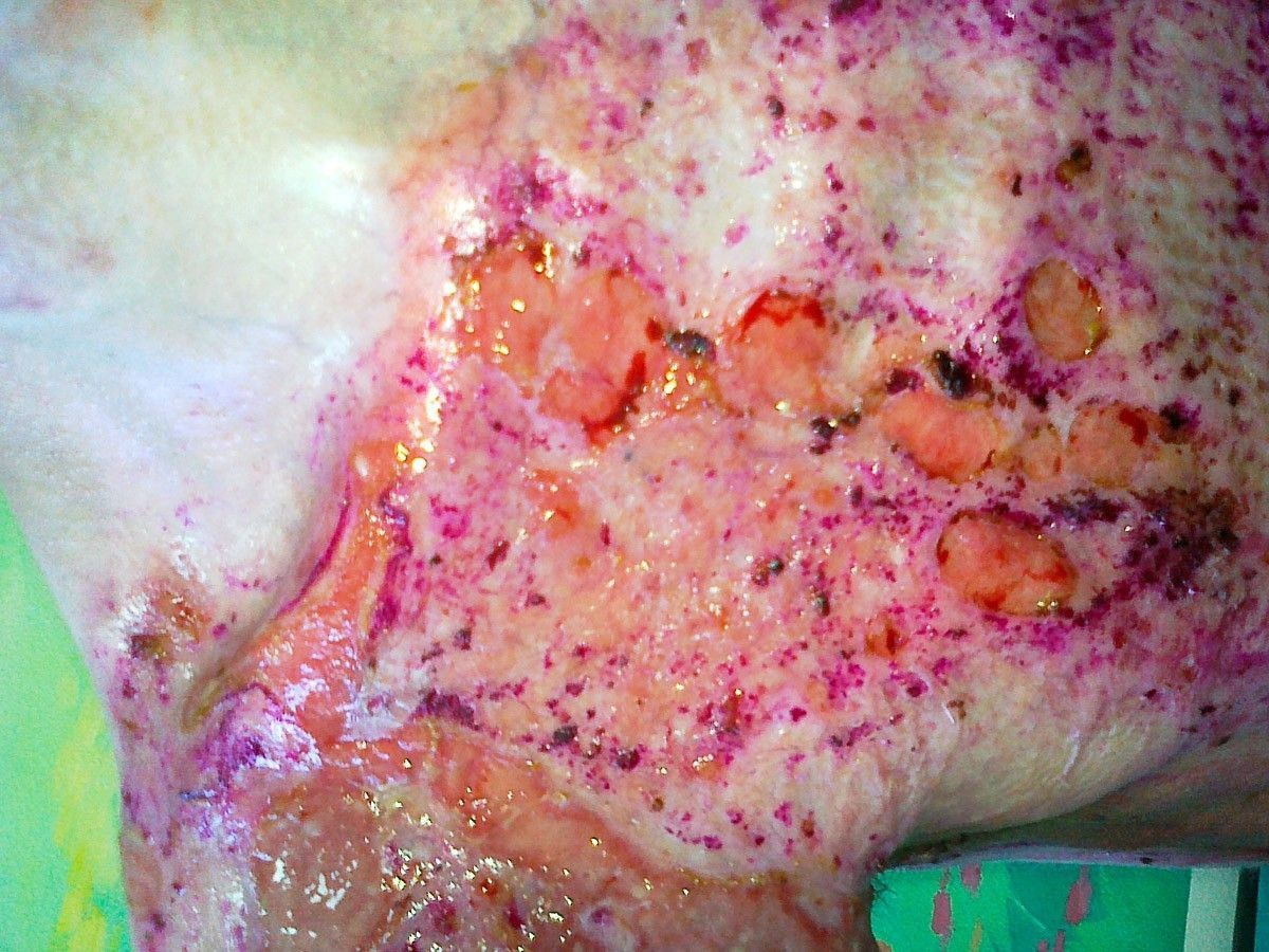 Tomasz Skiba po wypadku przy pracy