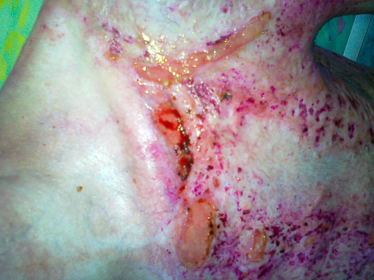 Tomasz Skiba po wypadku przy pracy