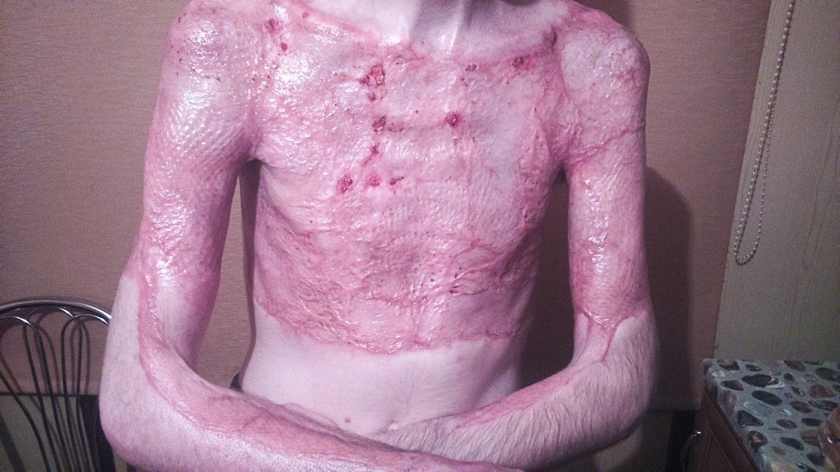 Tomasz Skiba po wypadku przy pracy