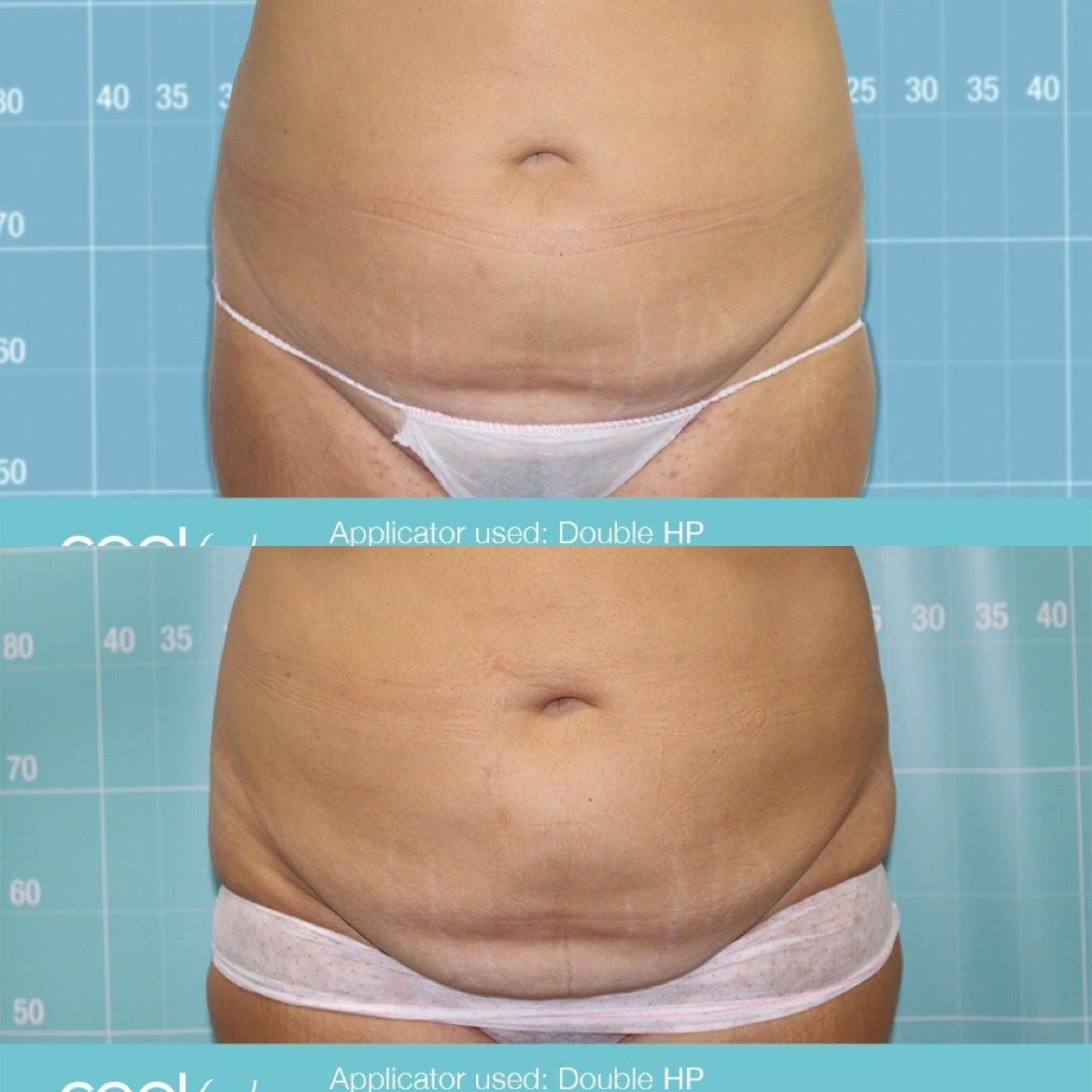 Widoczne rezultaty zaczynają się pojawiać po 2 tygodniach