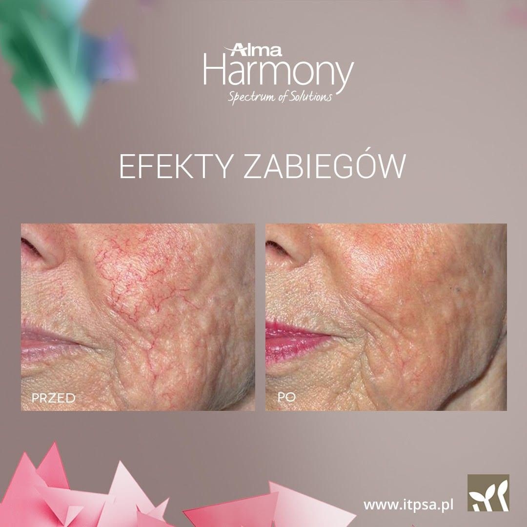 Efekty zabiegów ALMA HARMONY XL PRO