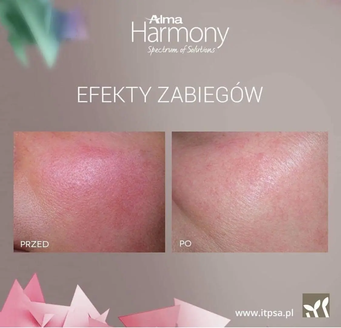 Efekty zabiegów ALMA HARMONY XL PRO