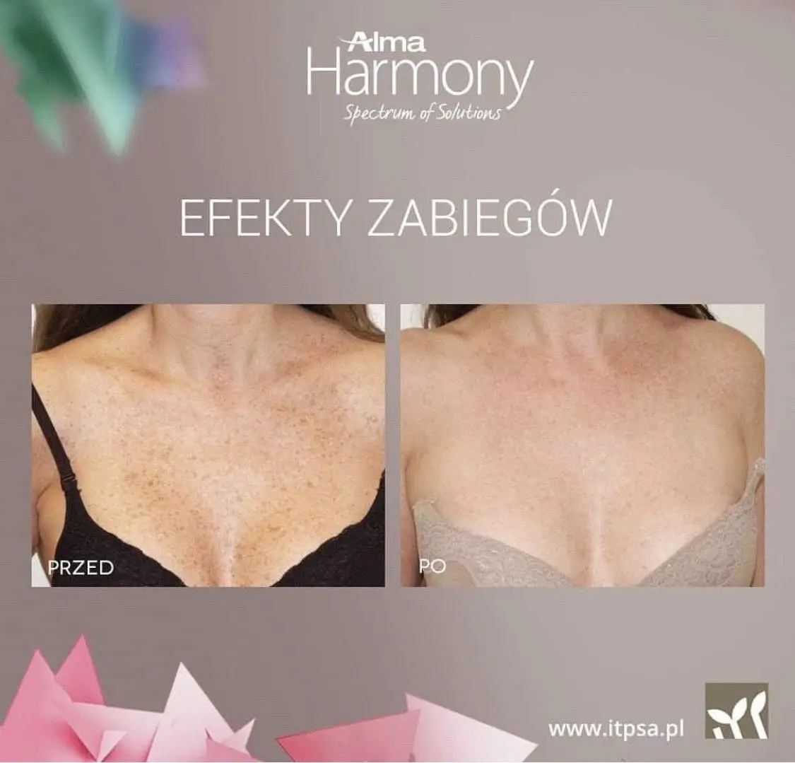 Efekty zabiegów ALMA HARMONY XL PRO