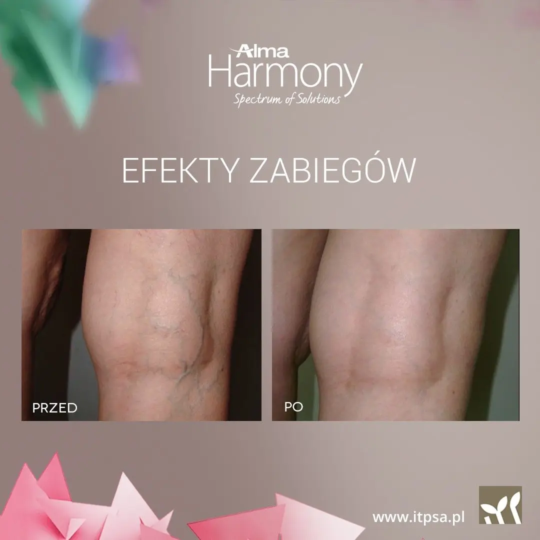 Lifting bez skalpela: Termolifting NIR i fotoodmładzanie ClearLift już są w DOMU URODY!