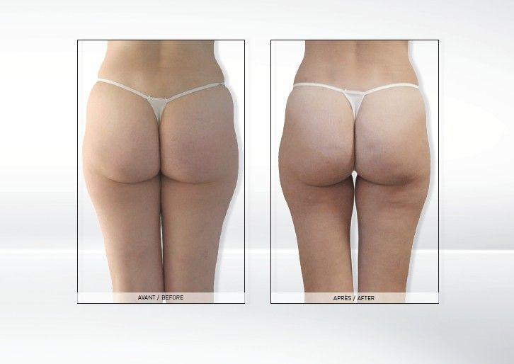 Efekty zabiegu Endermologie LPG Alliance