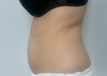 Accent prime Brzuch przed i po zabiegu