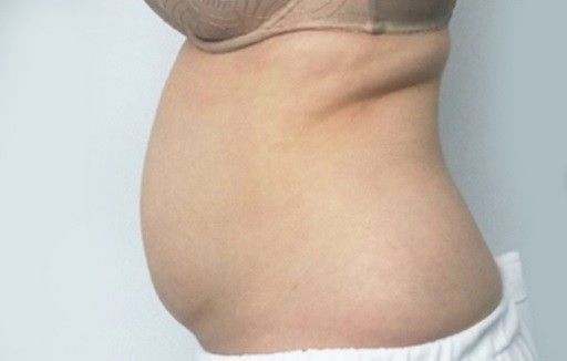 Accent prime Brzuch przed i po zabiegu