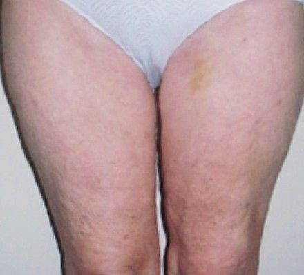 Uda przed i po zabiegu Accent Prime