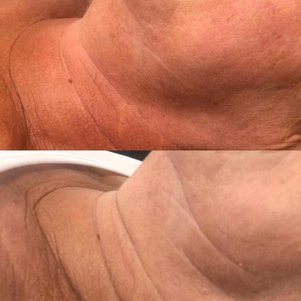 Efekty zabiegu uzyskane w Domu Urody