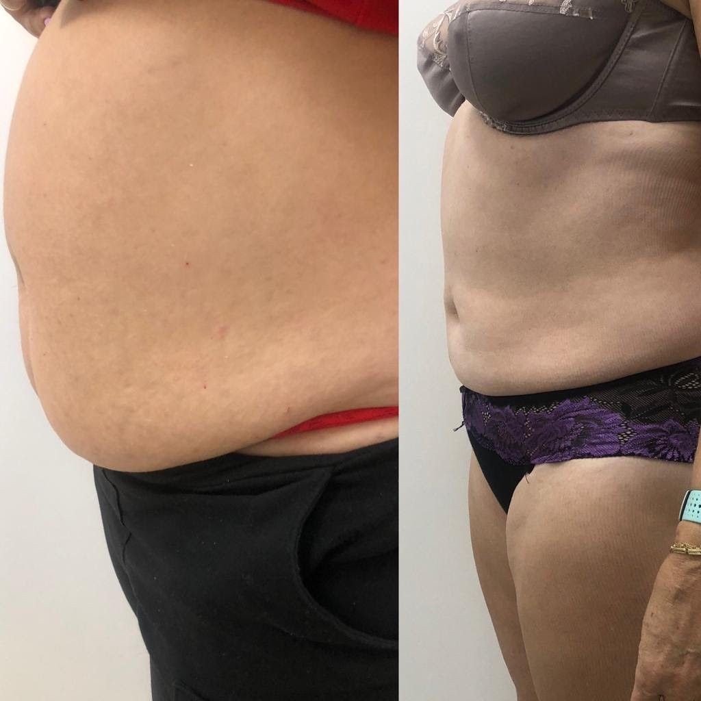 Efekty zabiegu uzyskane w Domu Urody