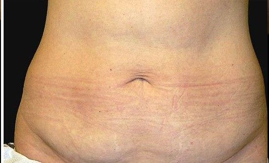 Niesamowite efekty zabiegów Accent Prime