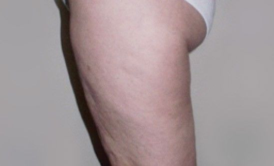 Niesamowite efekty zabiegów Accent Prime