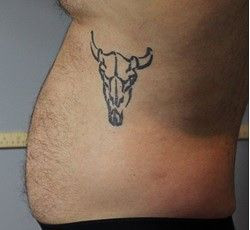 Niesamowite efekty zabiegów Accent Prime