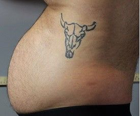 Niesamowite efekty zabiegów Accent Prime