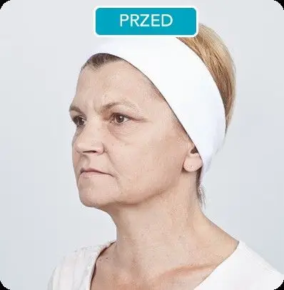Termolifting Zafirro przed i po