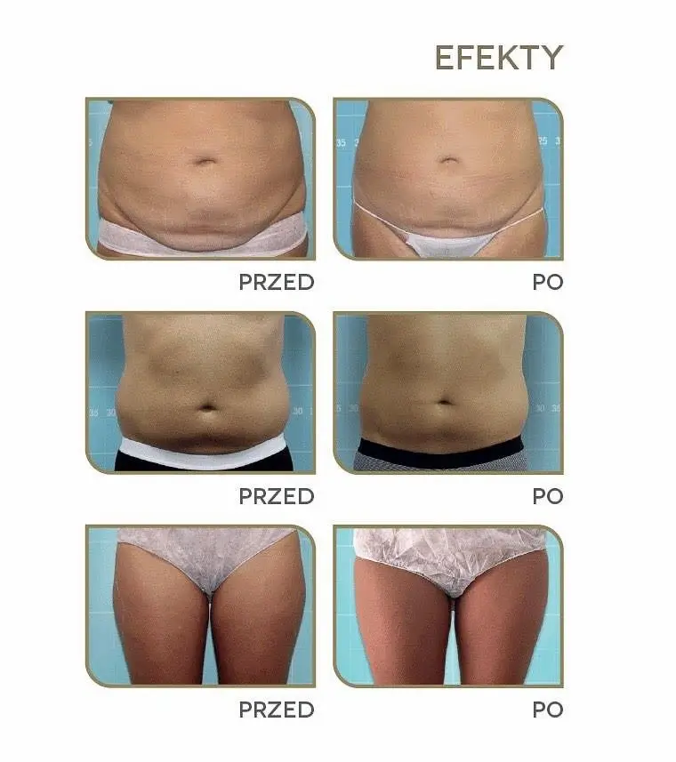 Prawdziwe efekty zabiegu kriolipoliza Cooltech w Domu Urody!