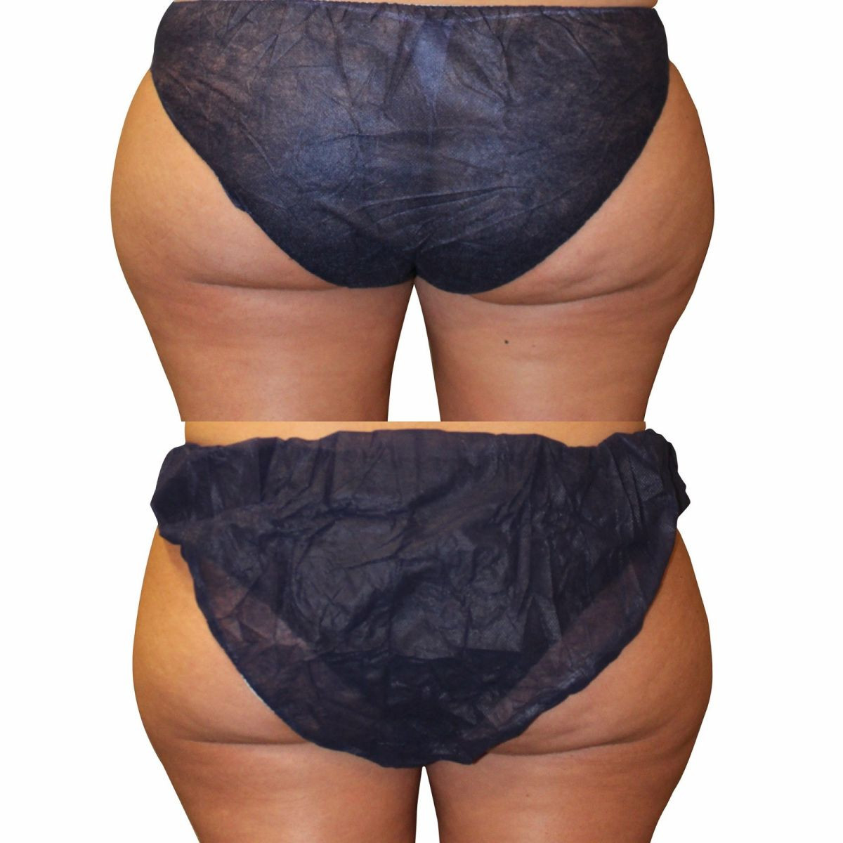 Prawdziwe efekty zabiegu kriolipoliza Cooltech w Domu Urody!