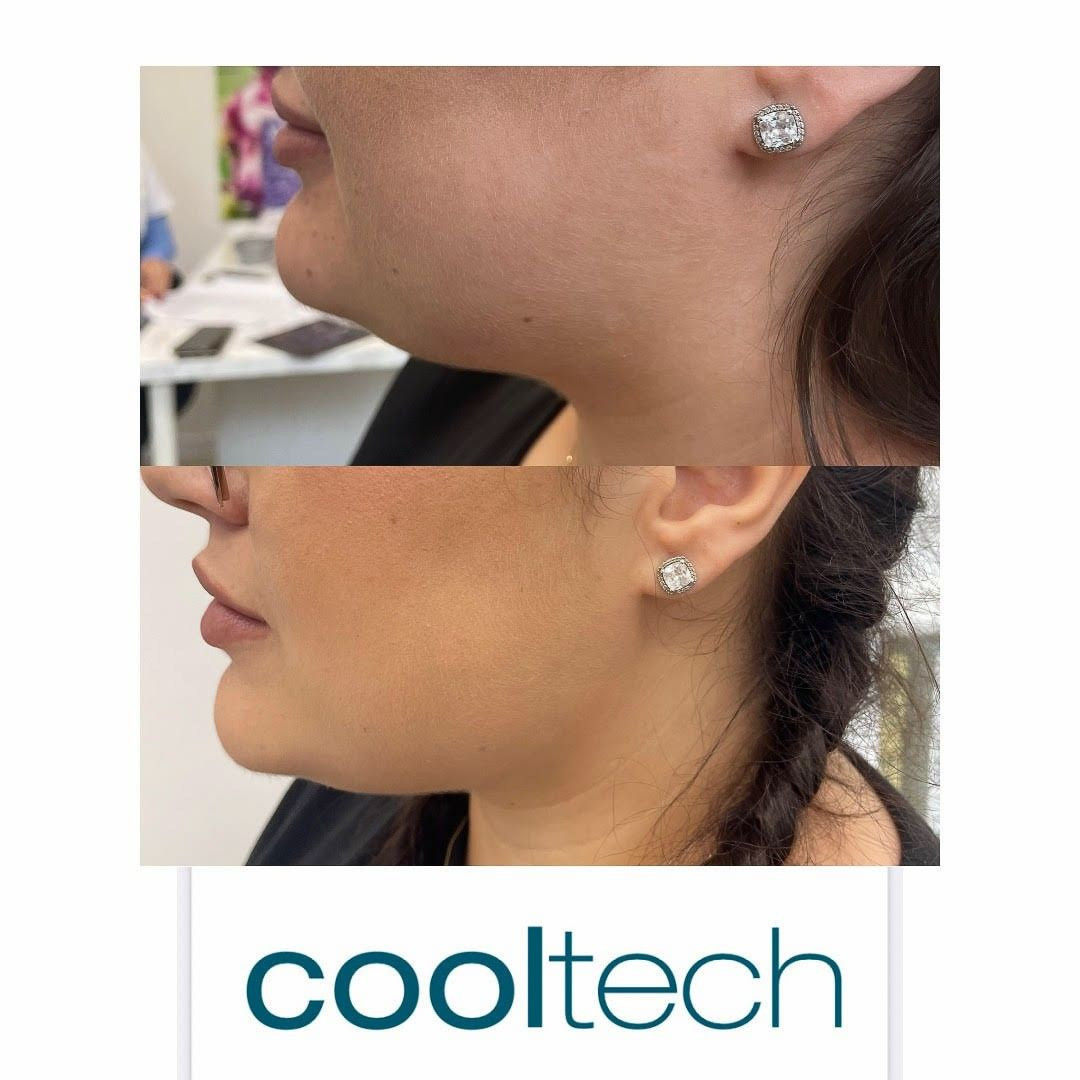 Prawdziwe efekty zabiegu kriolipoliza Cooltech w Domu Urody!