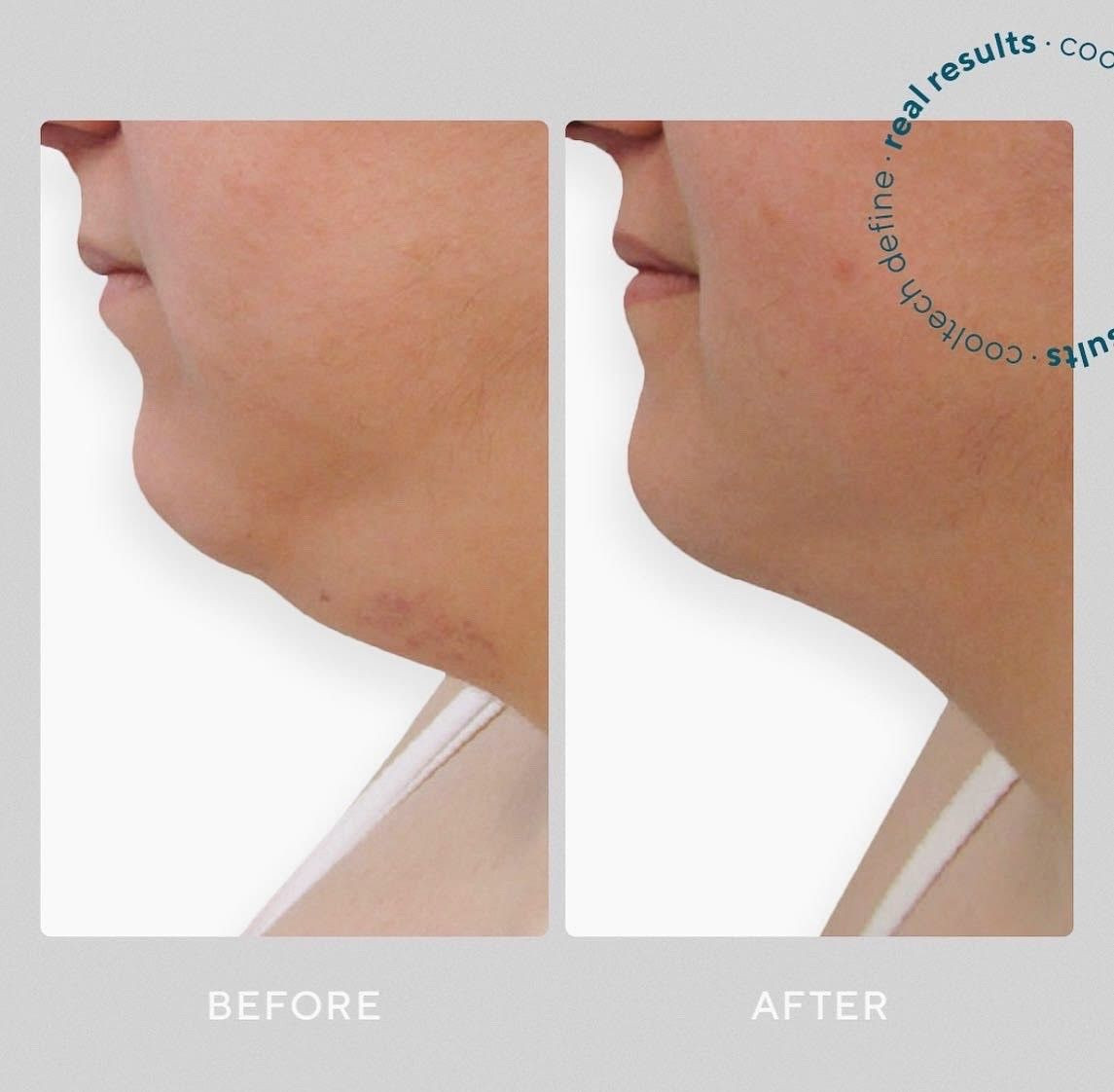 Prawdziwe efekty zabiegu kriolipoliza Cooltech w Domu Urody!