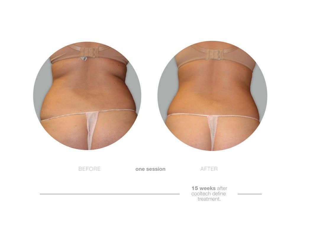Prawdziwe efekty zabiegu kriolipoliza Cooltech w Domu Urody!