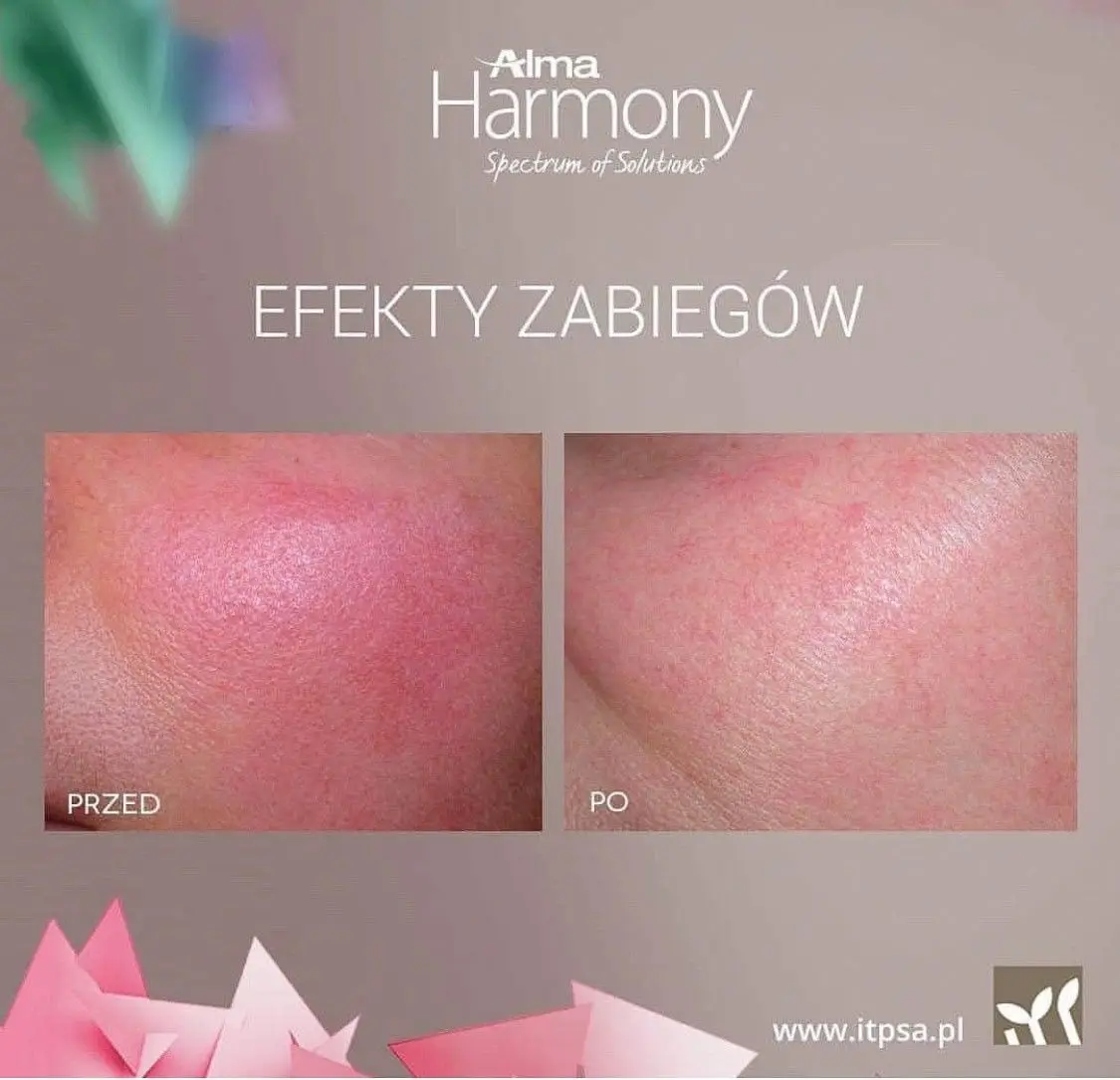 Efekty zabiegu