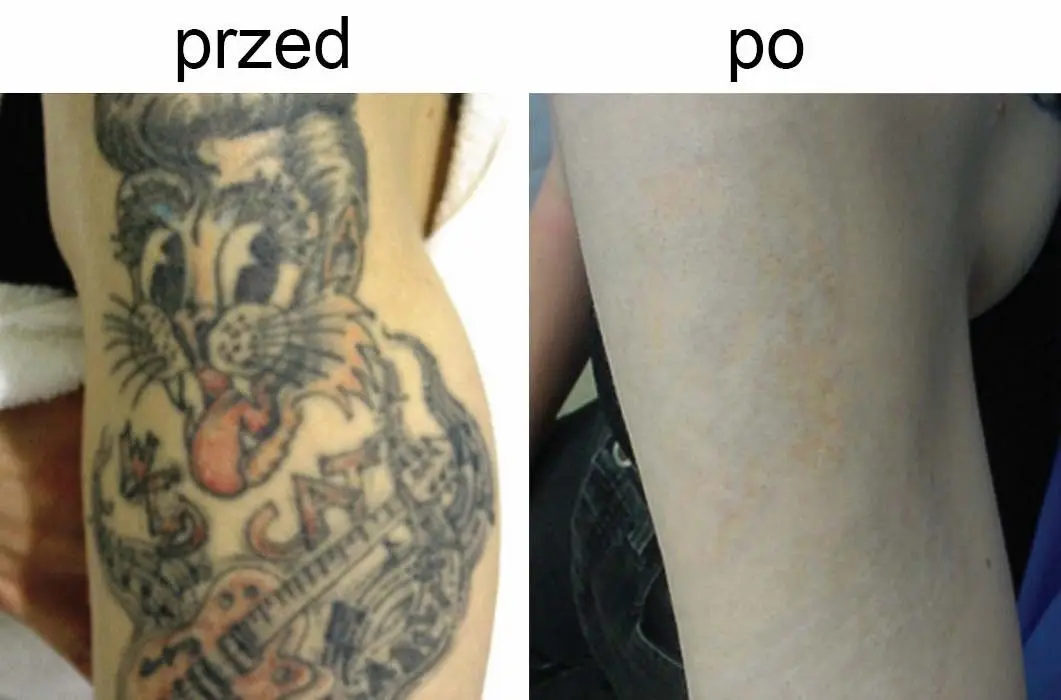 Usuwanie tatuaży