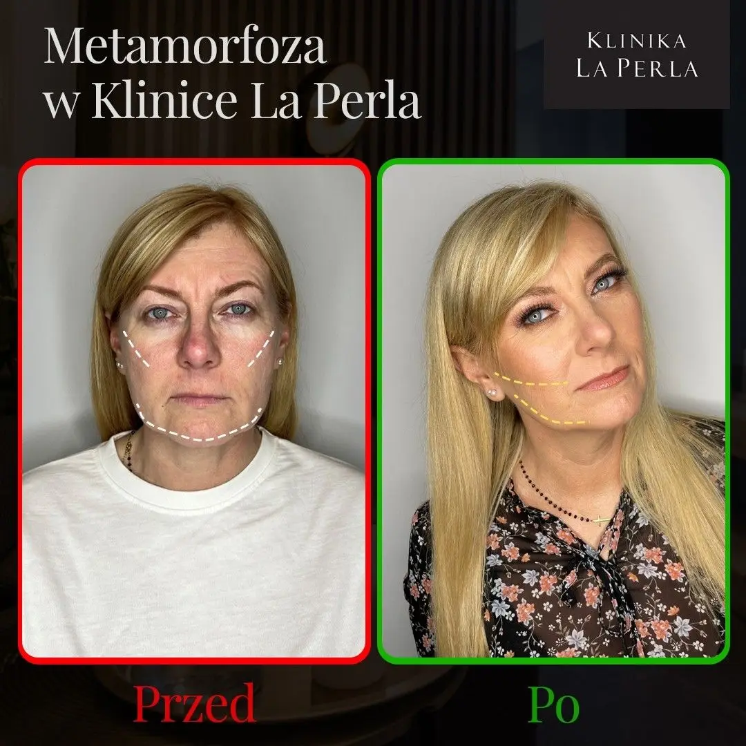 Metamorfoza w Klinice La Perla