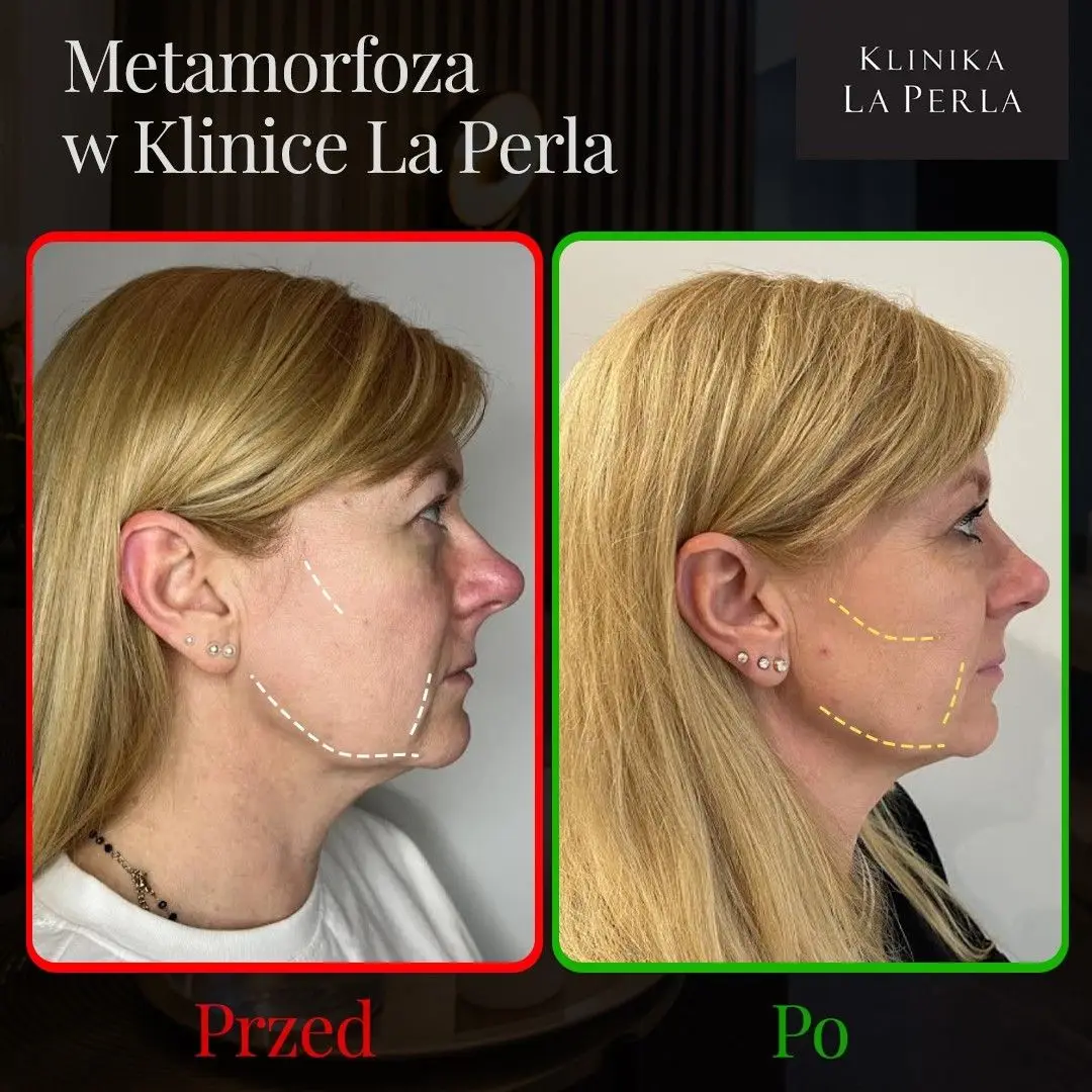 Metamorfoza w Klinice La Perla