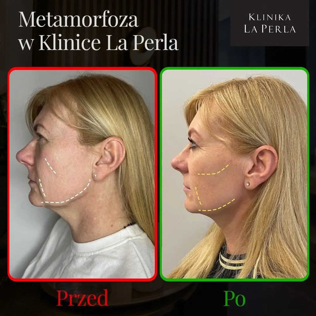 Metamorfoza w Klinice La Perla