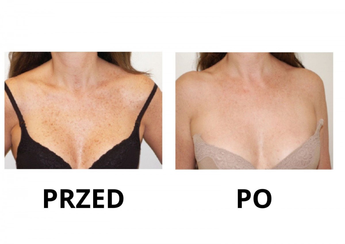 Nowa maszyna w Bednarczuk Beuty Clinic efekty zabiegów