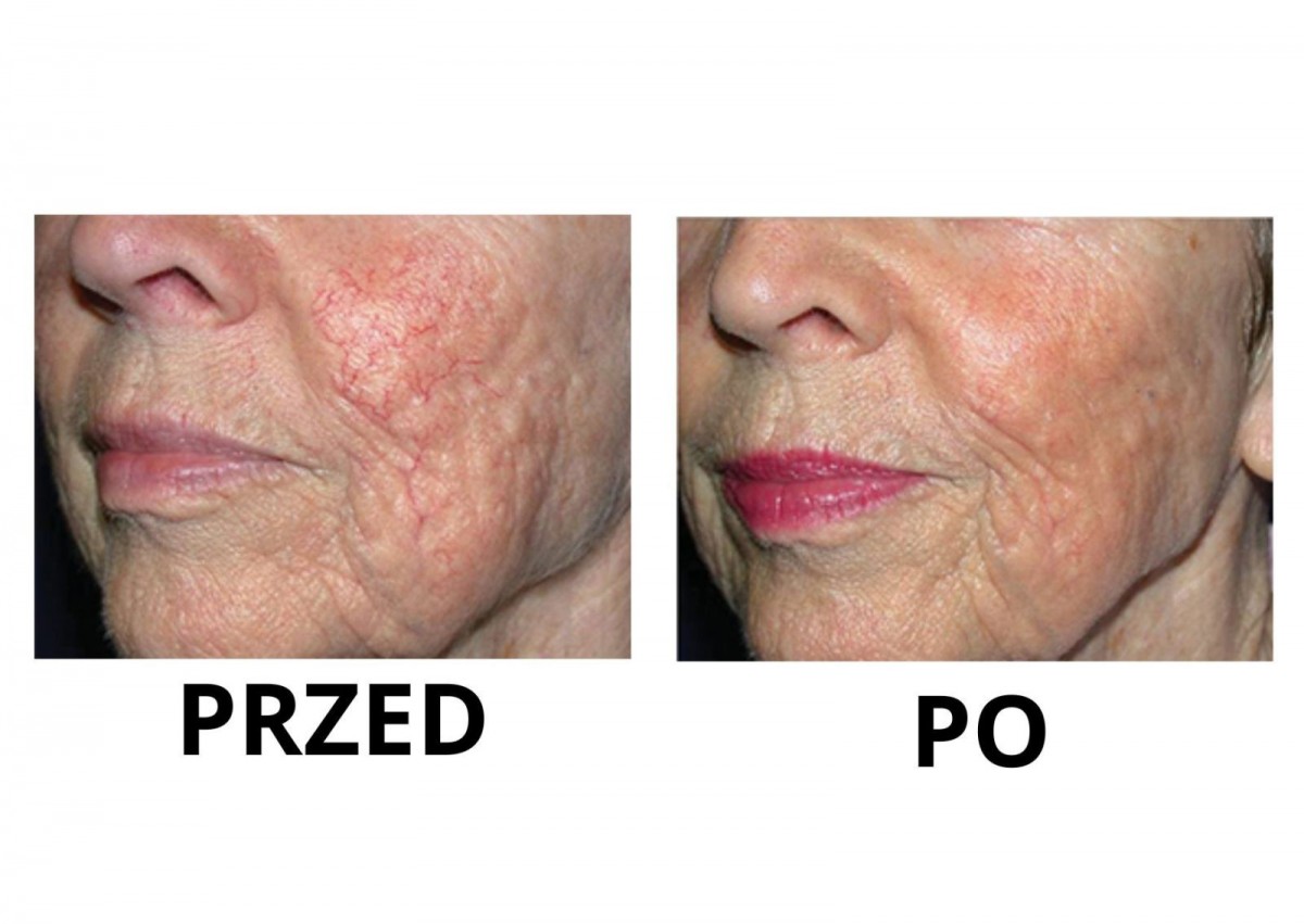 Nowa maszyna w Bednarczuk Beuty Clinic efekty zabiegów