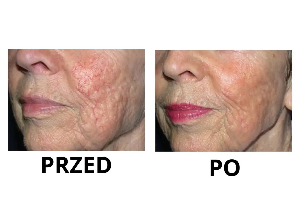 Nowa maszyna w Bednarczuk Beuty Clinic efekty zabiegów