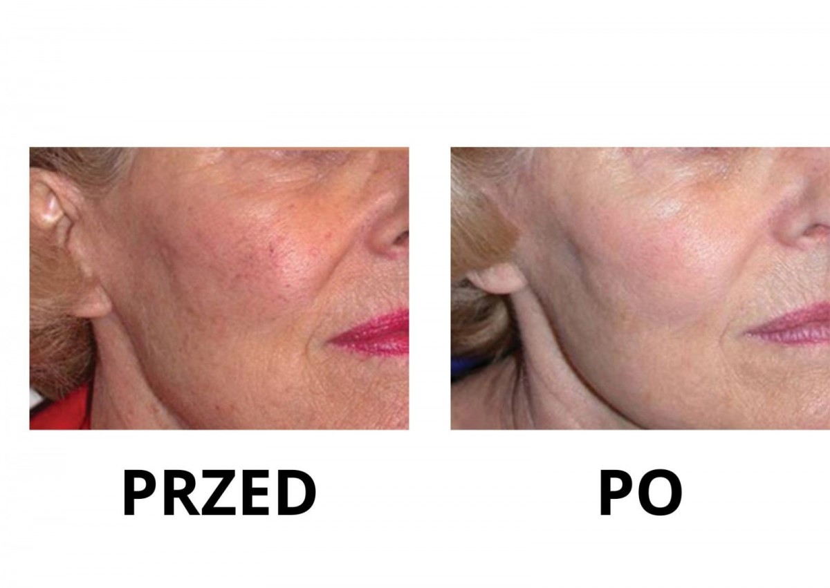 Nowa maszyna w Bednarczuk Beuty Clinic efekty zabiegów