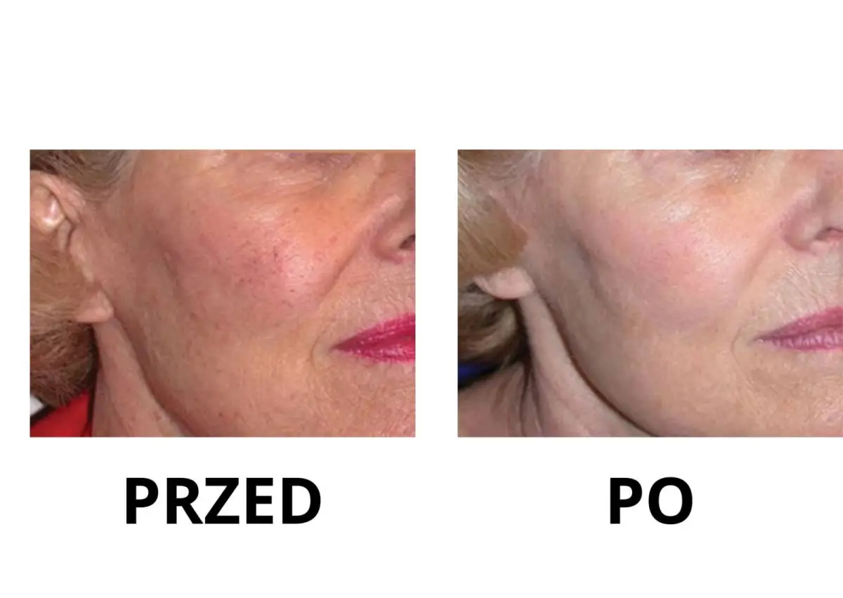 Nowa maszyna w Bednarczuk Beuty Clinic efekty zabiegów