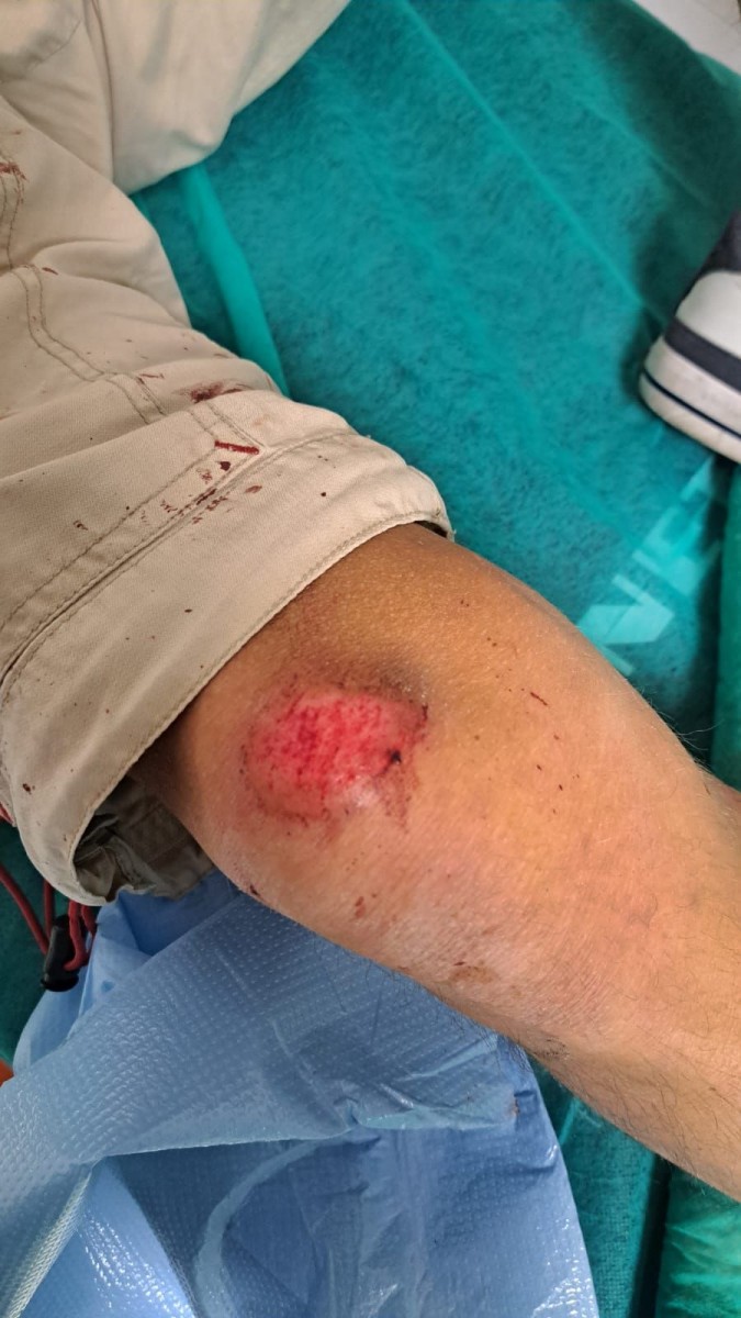 Potrącony rowerzysta