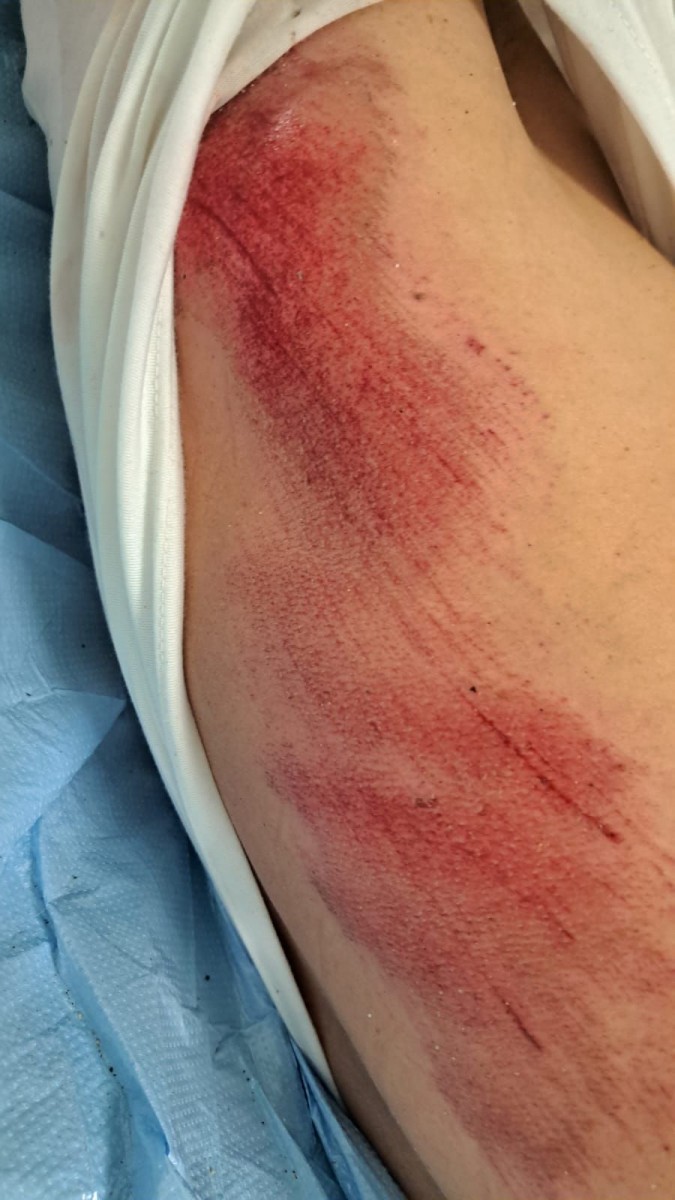 Potrącony rowerzysta