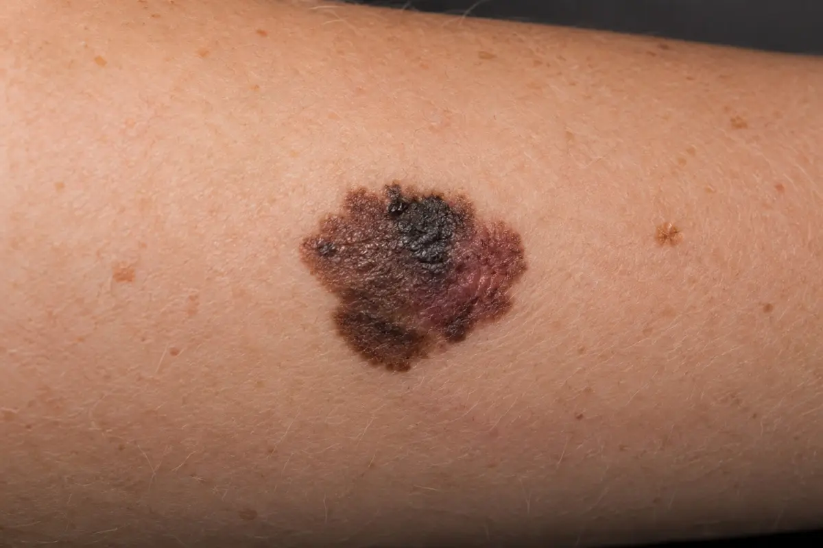 Cancerous mole on the skin