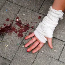 Zobacz zdjęcie: W czasie naszej wizyty jeden z chłopców ranił się w rękę. Wypadki w zaniedbanym skateparku są na porządku dziennym.