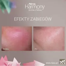 Zobacz zdjęcie: Efekty zabiegów ALMA HARMONY XL PRO