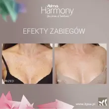 Zobacz zdjęcie: Efekty zabiegów ALMA HARMONY XL PRO