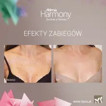 Zobacz zdjęcie: Lifting bez skalpela: Termolifting NIR i fotoodmładzanie ClearLift już są w DOMU URODY!