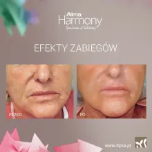 Zobacz zdjęcie: Lifting bez skalpela: Termolifting NIR i fotoodmładzanie ClearLift już są w DOMU URODY!