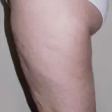 Zobacz zdjęcie: Niesamowite efekty zabiegów Accent Prime